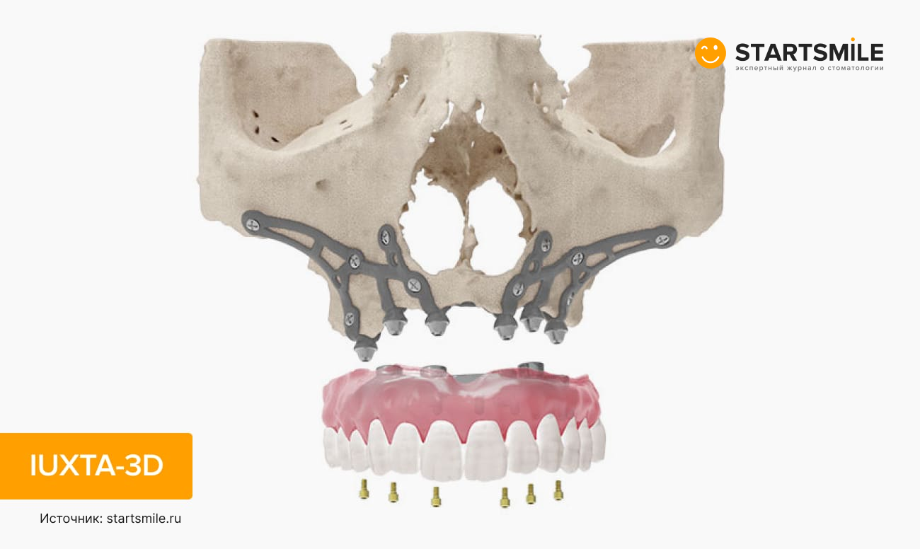 Фото имплантационной системы IUXTA-3D.