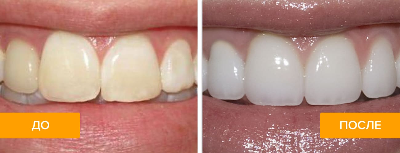 Фото пациента до и после установки люминиров