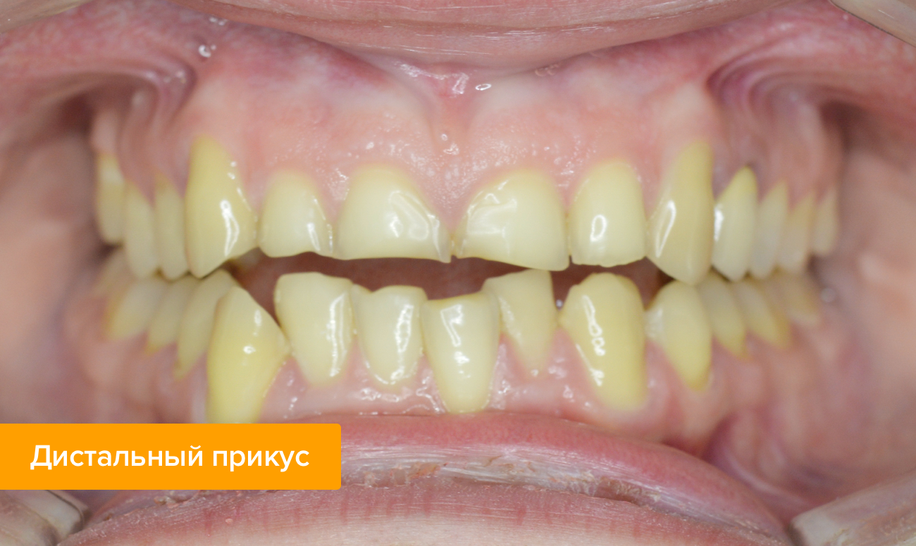Фото дистального прикуса