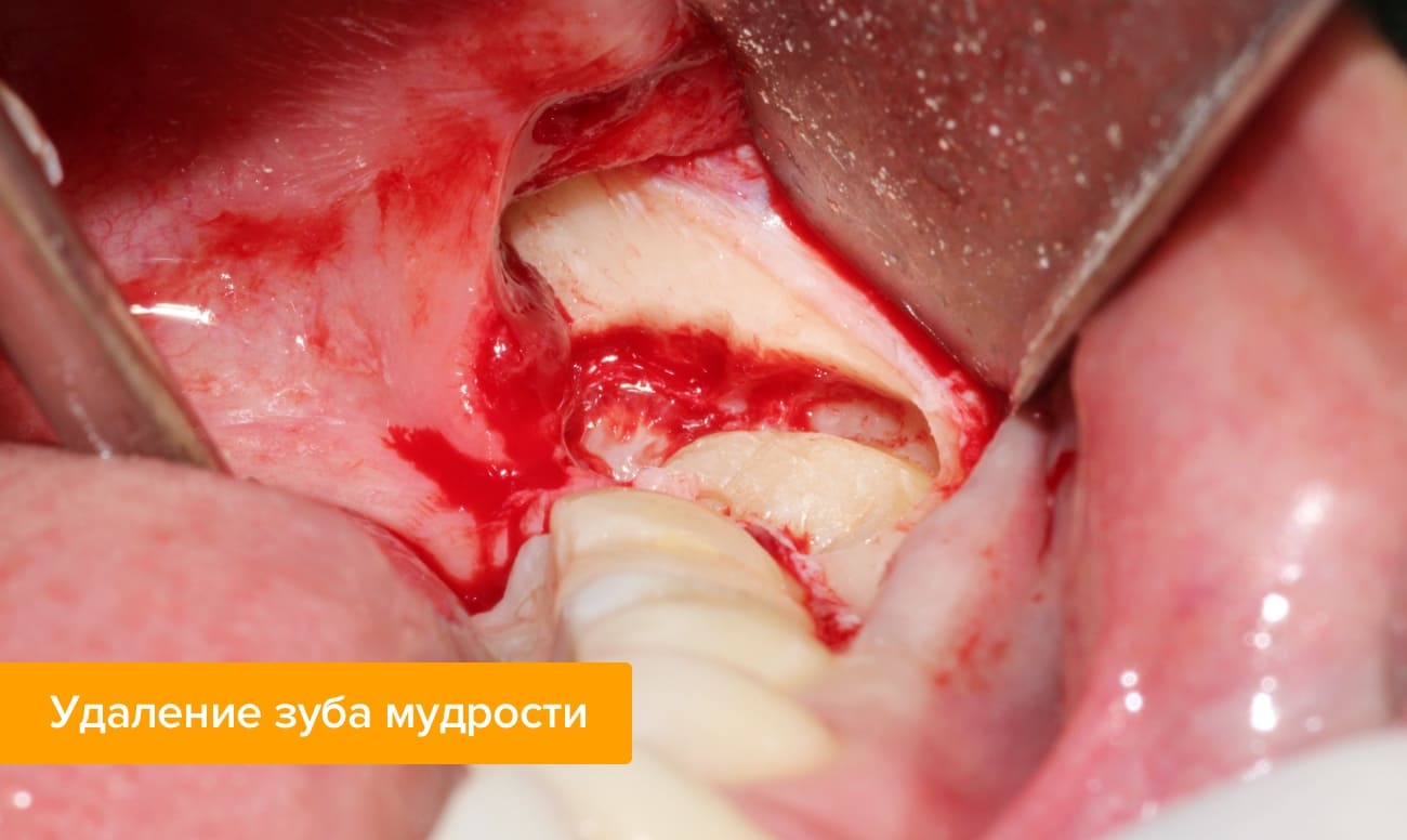 Можно ли лечить зубы при грудном вскармливании? | Стоматология «Денталюкс-М» (Москва)