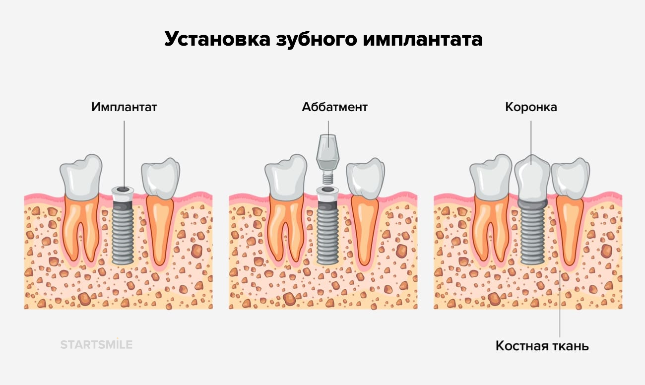 Установка зубного имплантата в картинках.