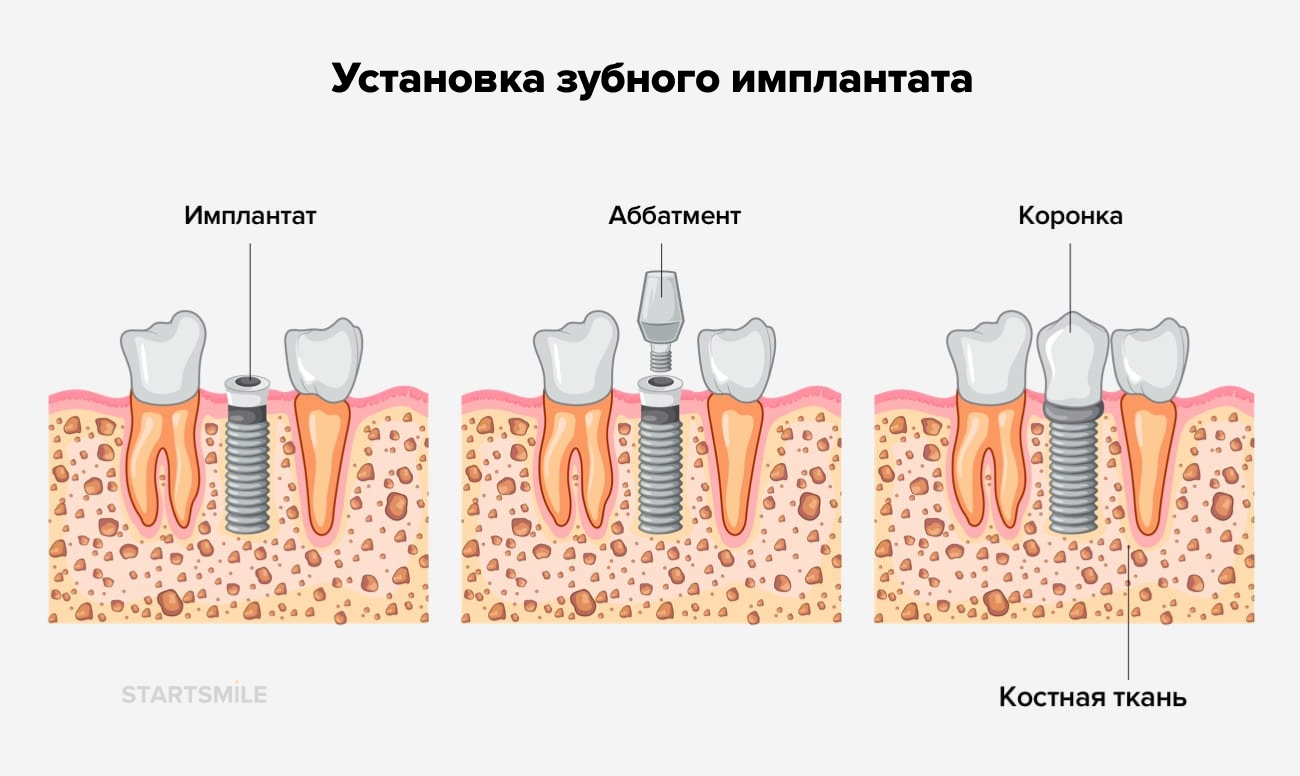 Можно ставить импланты при диабете. Схема установки зубного имплантата. Этапы имплантации зубов. Стадии имплантации зубов. Этапы установления имплантата зуба.