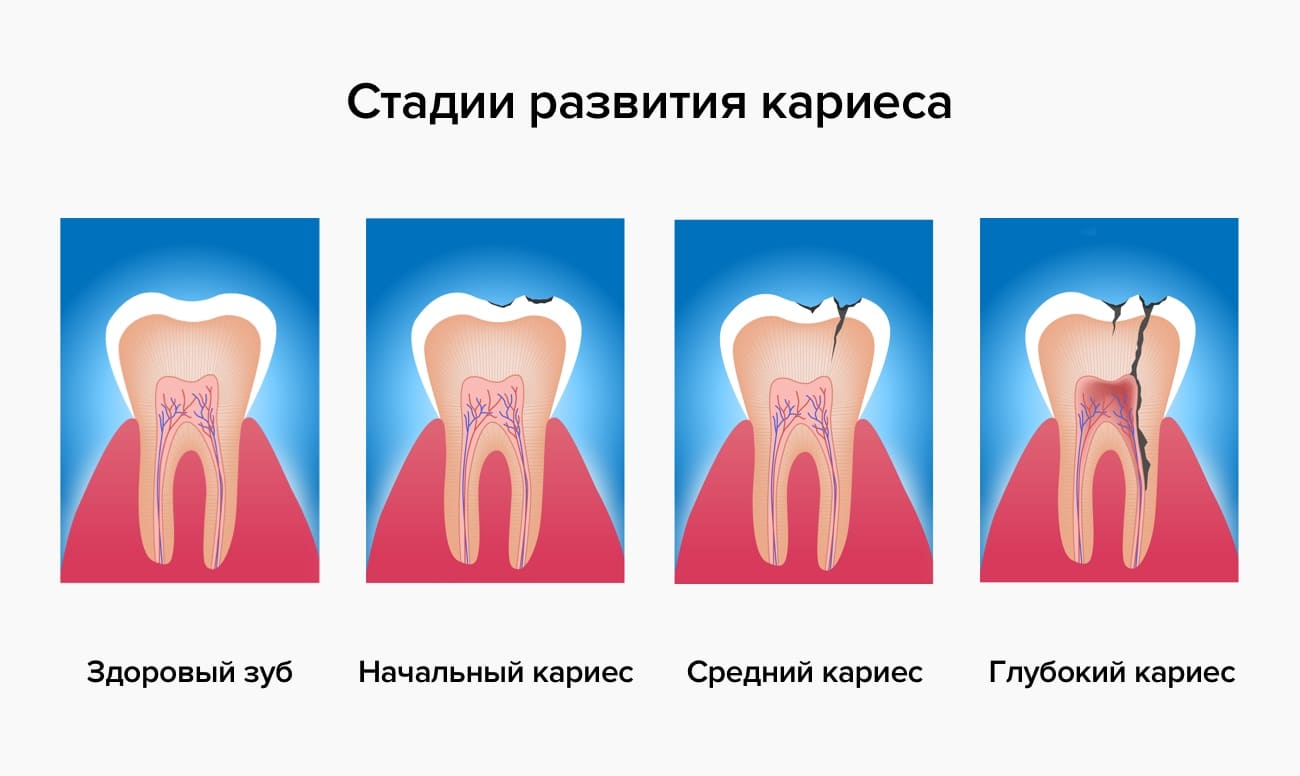 Стадии развития кариеса в картинках