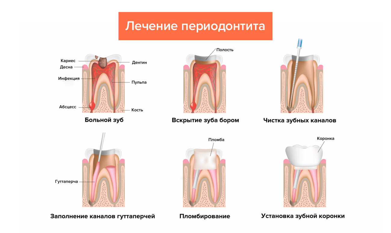 Признаки лечения зубов. Хронический периодонтит пульпит. Хронический фиброзный периодонтит схема. Схема этапы лечения воспаления корня зуба. Хронический периодонтит 2.5 зуба.