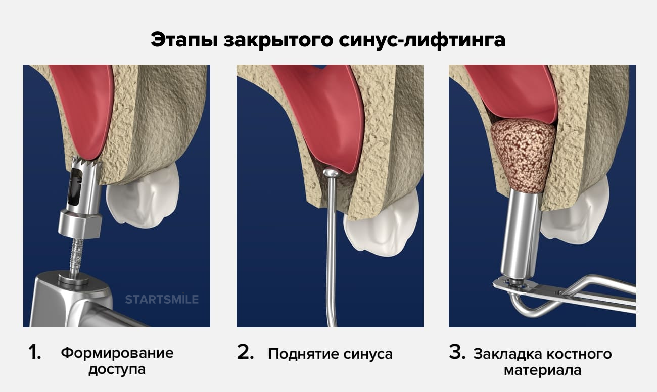 Презентация закрытый синус лифтинг