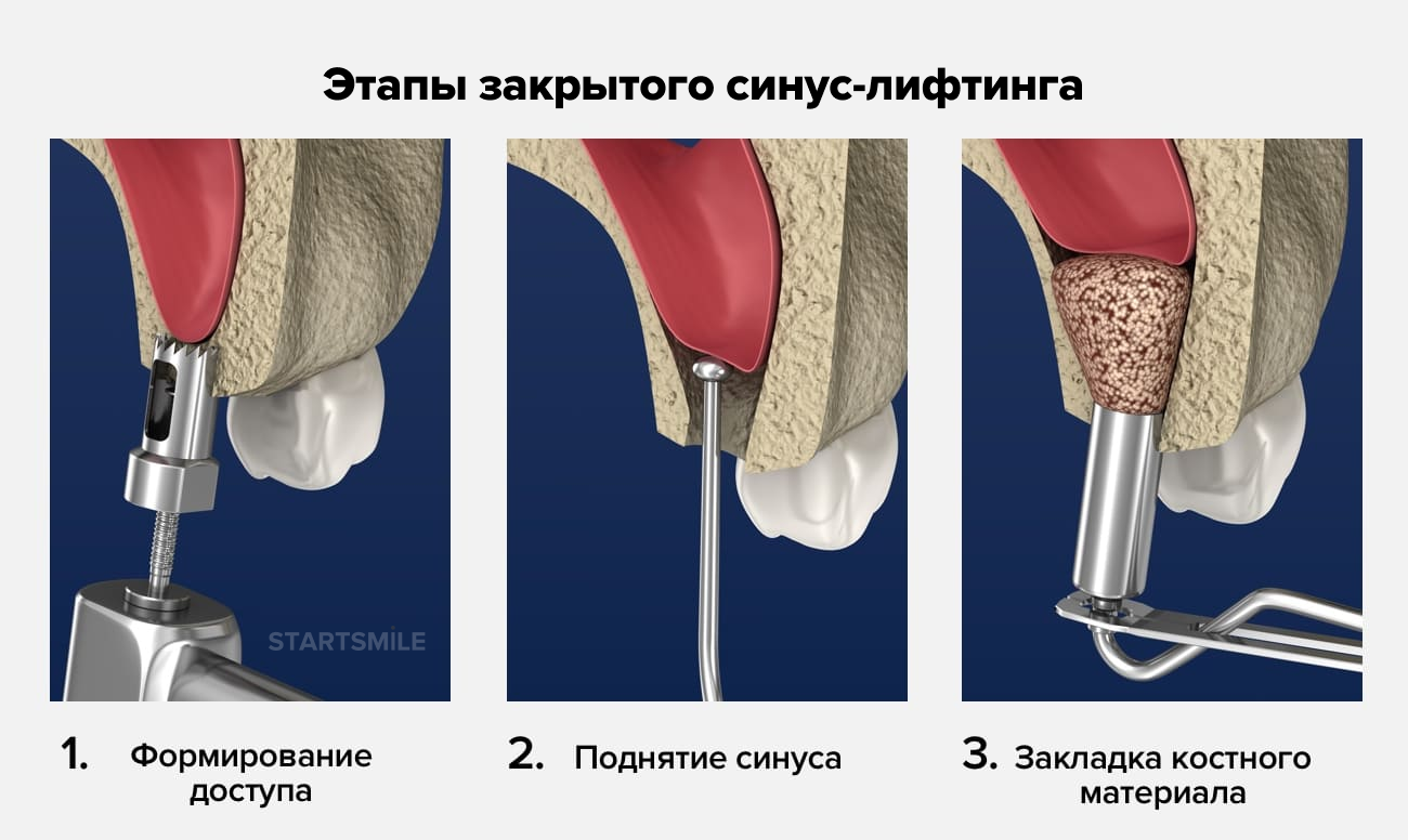 Синуслифтинг открытый. Закрытый синус лифтинг показания, методика. Открытый и закрытый синус лифтинг методика. Безостеотомный синус лифтинг. Синус лифтинг закрытая методика.