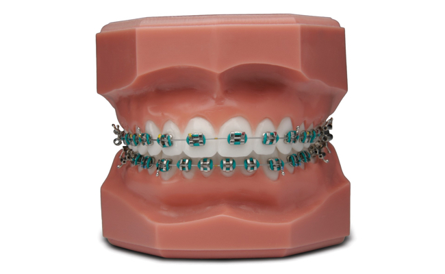 Брекеты Dentsply OmniArch на зубах Фото брекетов Dentsply OmniArch на зубах
