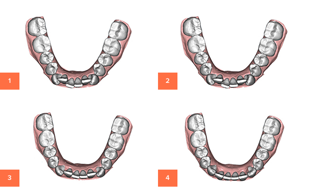 Лечение на капах 3D Smile в картинках
