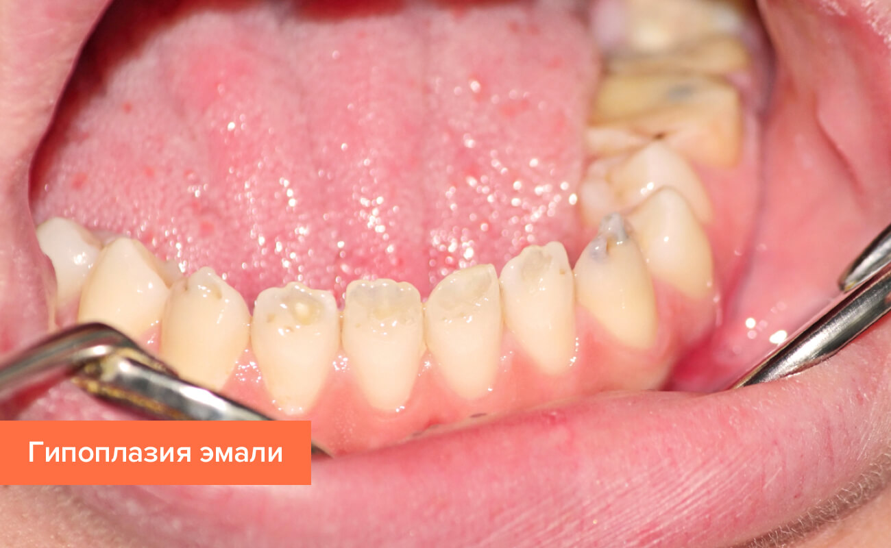 Фото гипоплазии эмали зубов