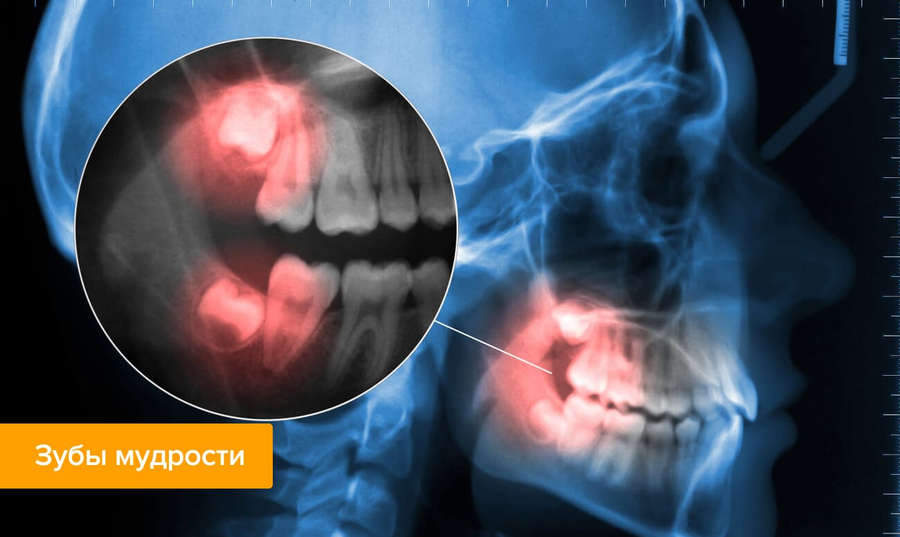 Зуб мудрости на рентгеновском снимке