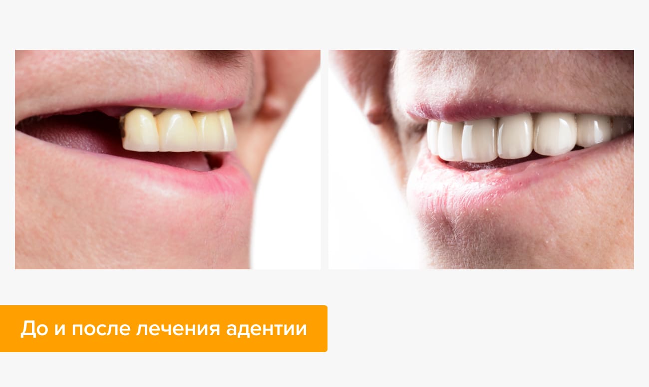 До и после лечения адентии Фото пациента до и после лечения адентии