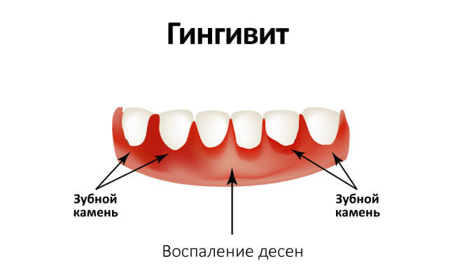 Гингивит в картинках