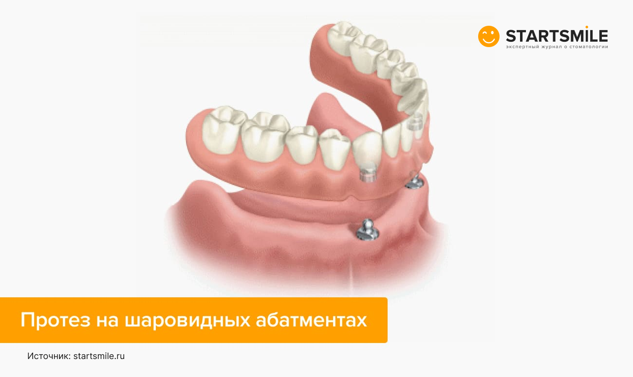 Шаровидное крепление съемного протеза на имплантах Шаровидное крепление съемного протеза на имплантах в картинках