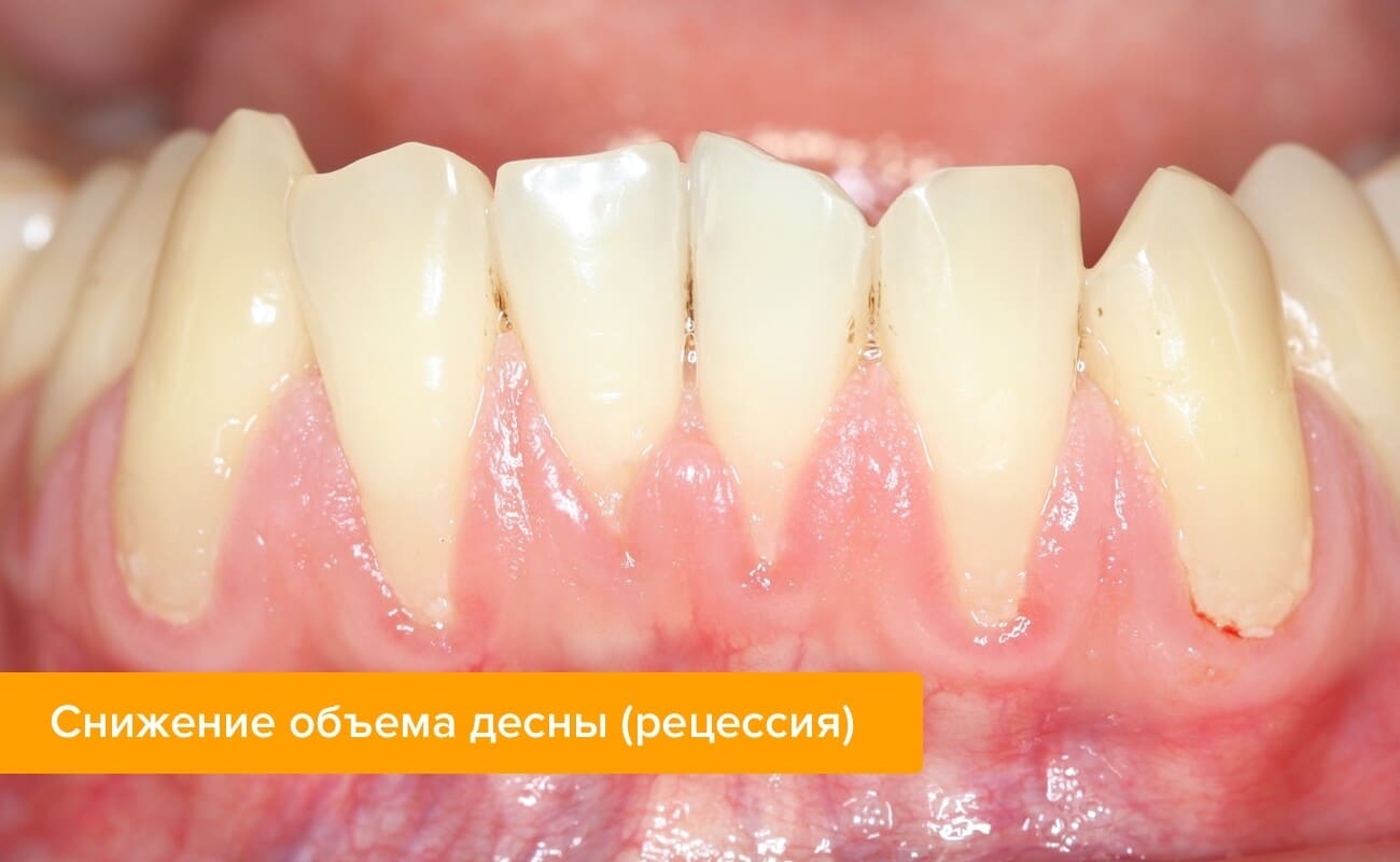 Фото рецессии десны