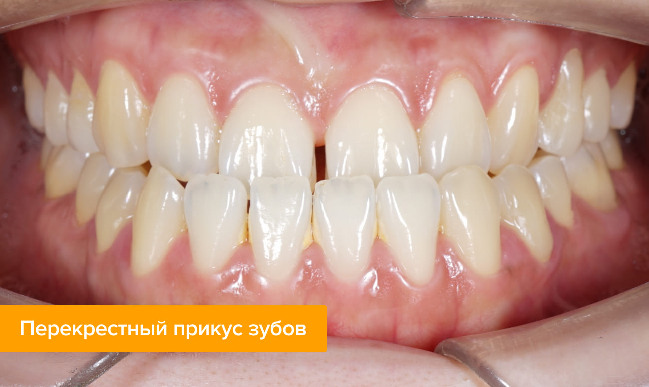 Что такое перекрестный прикус. Смотреть фото Что такое перекрестный прикус. Смотреть картинку Что такое перекрестный прикус. Картинка про Что такое перекрестный прикус. Фото Что такое перекрестный прикус
