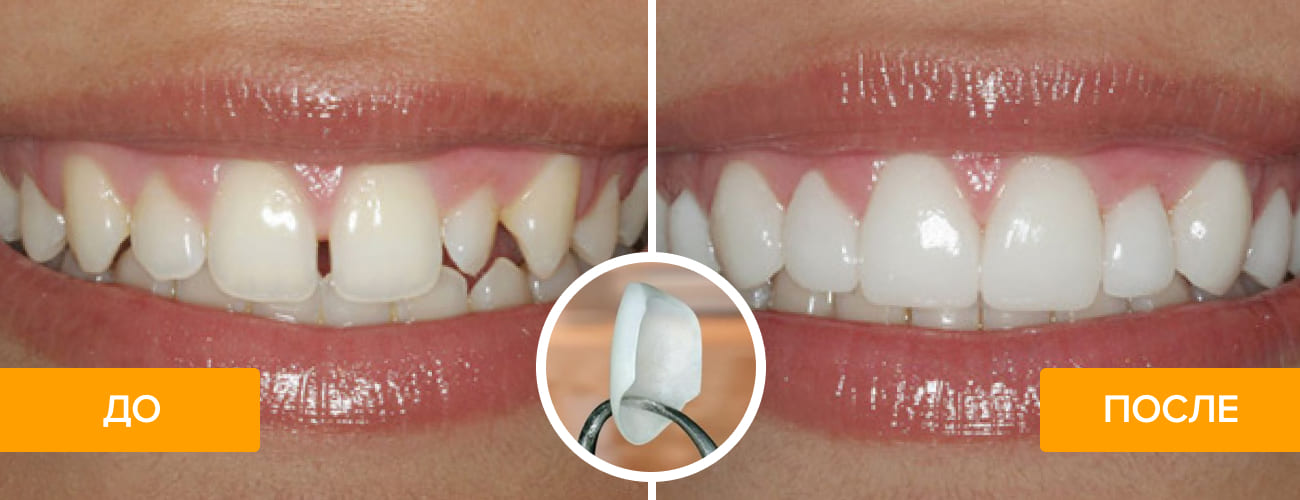 Фото зубов до и после установки люминиров