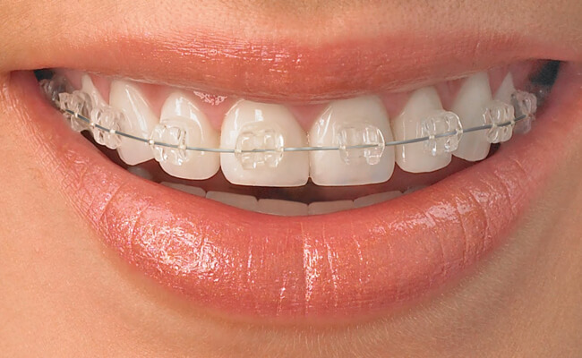 Брекеты Dentsply Mystique на зубах Фото брекетов Dentsply Mystique на зубах