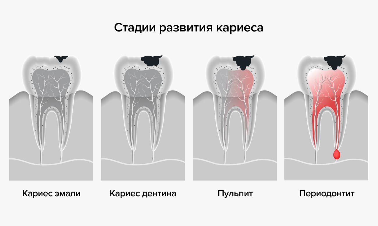 Как уменьшить боль в зубе