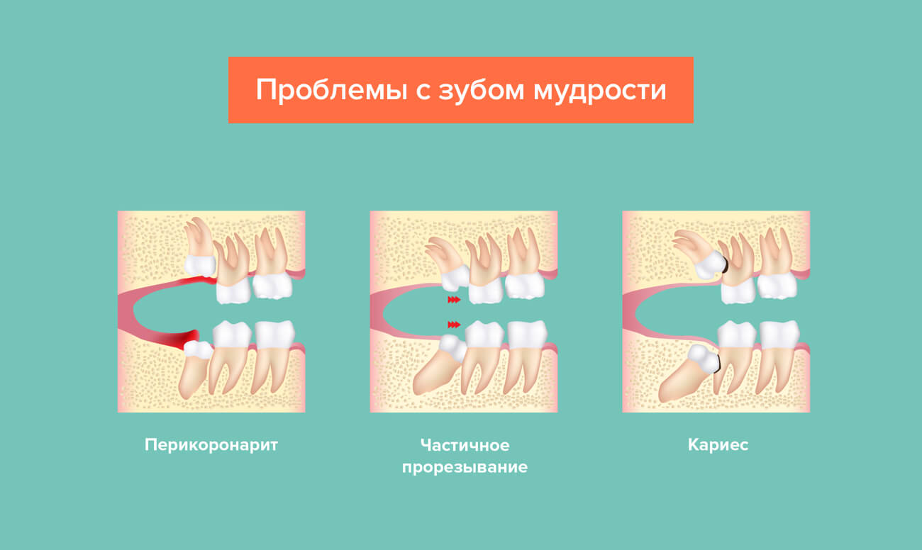 Проблемы с зубом мудрости в картинках Проблемы с зубом мудрости в картинках