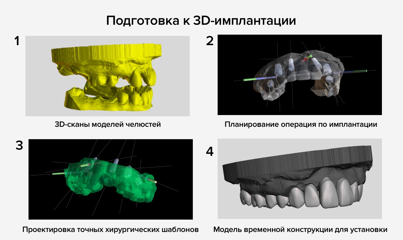 Подготовка к 3D-имплантации
