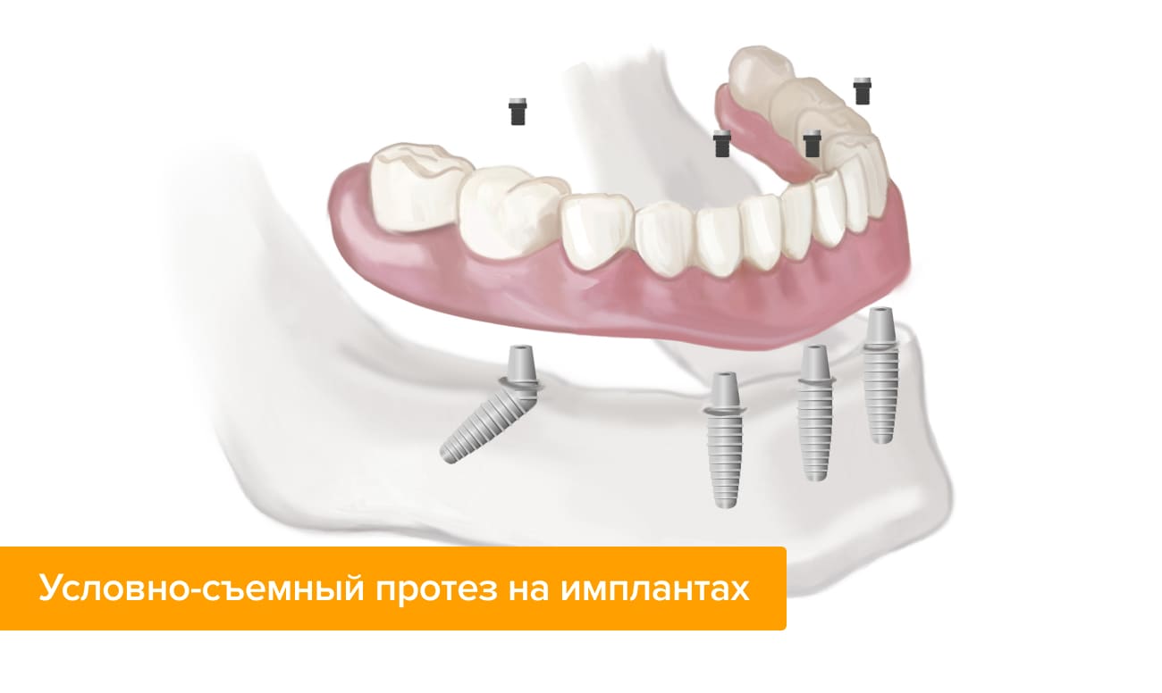 Условно-съемный протез на имплантах Фото условно-съемного протеза на имплантах
