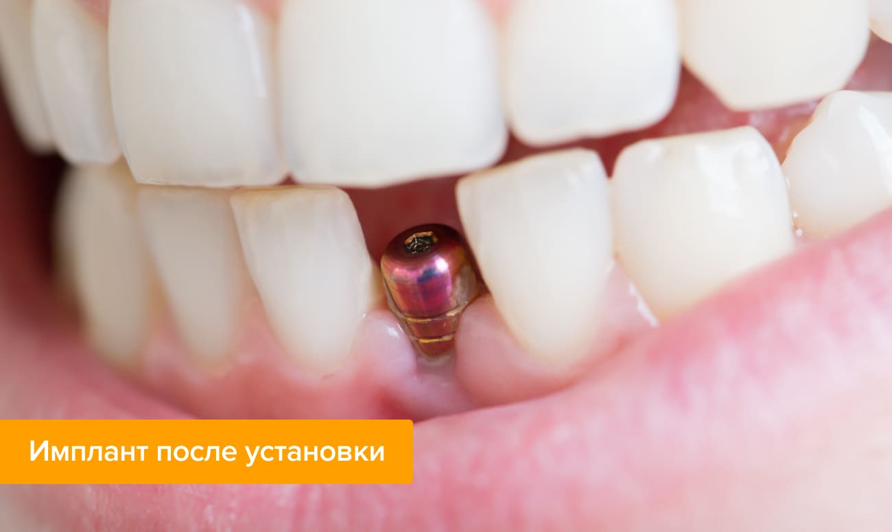 Что будет если не ставить имплант. Смотреть фото Что будет если не ставить имплант. Смотреть картинку Что будет если не ставить имплант. Картинка про Что будет если не ставить имплант. Фото Что будет если не ставить имплант