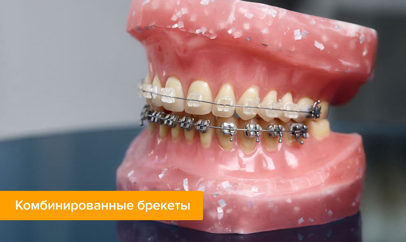 Комбинированные брекеты на зубах Фото комбинированных брекетов на зубах