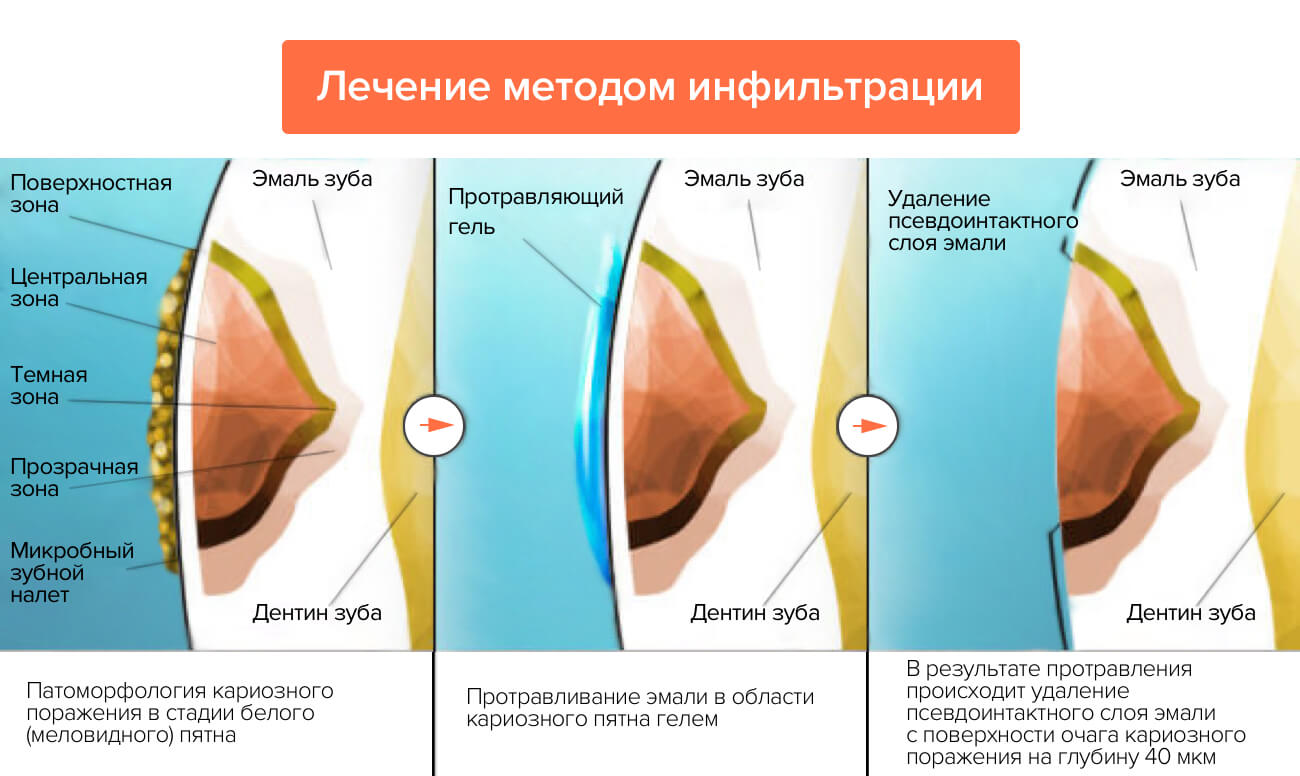 Лечение методом инфильтрации в картинках