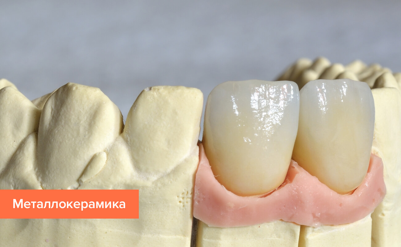 Фото металлокерамической коронки