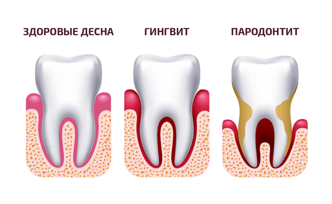 Фото этапов развития пародонтита в картинках