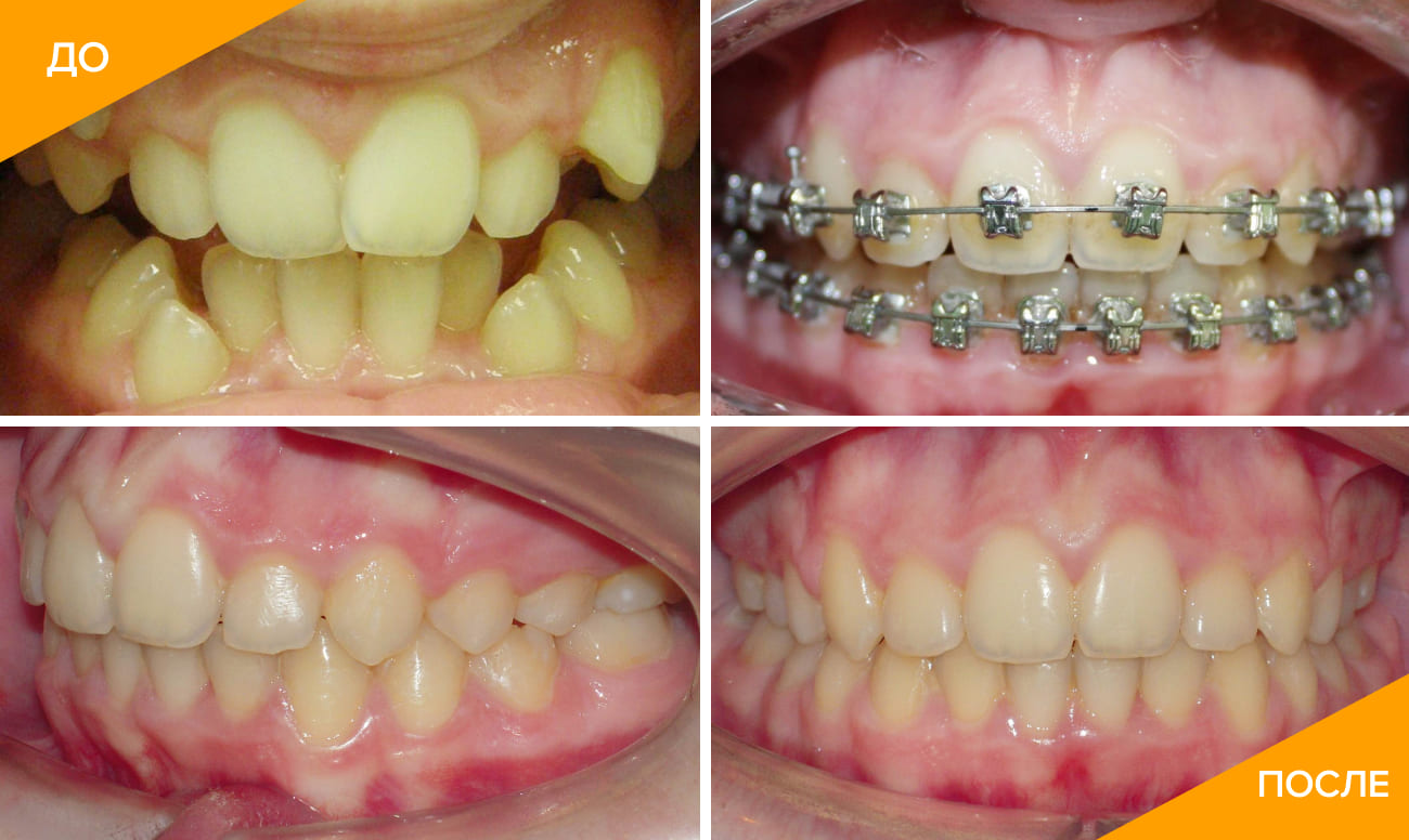 Фото пациента на различных этапах лечения беретами Damon в стоматологической клинике «Интердент»