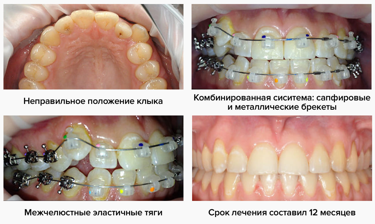 Этапы лечения безлигатурными брекетами Фото на разных этапах лечения безлигатурными брекетами