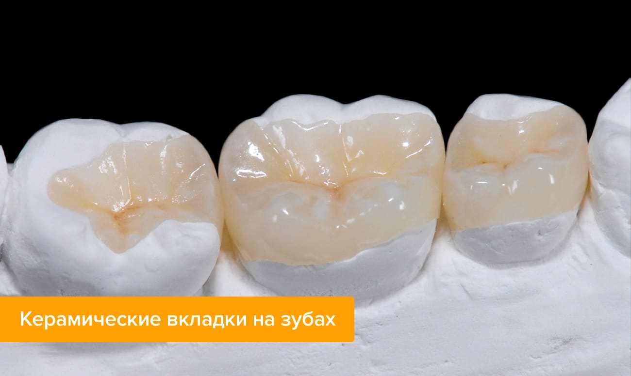 Фото керамических вкладок на зубах