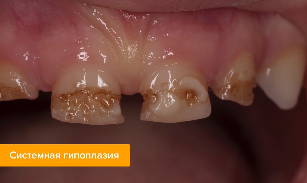 Гипоплазия эмали → причины, симптомы, диагностика и лечение Гипоплазия эмали у детей