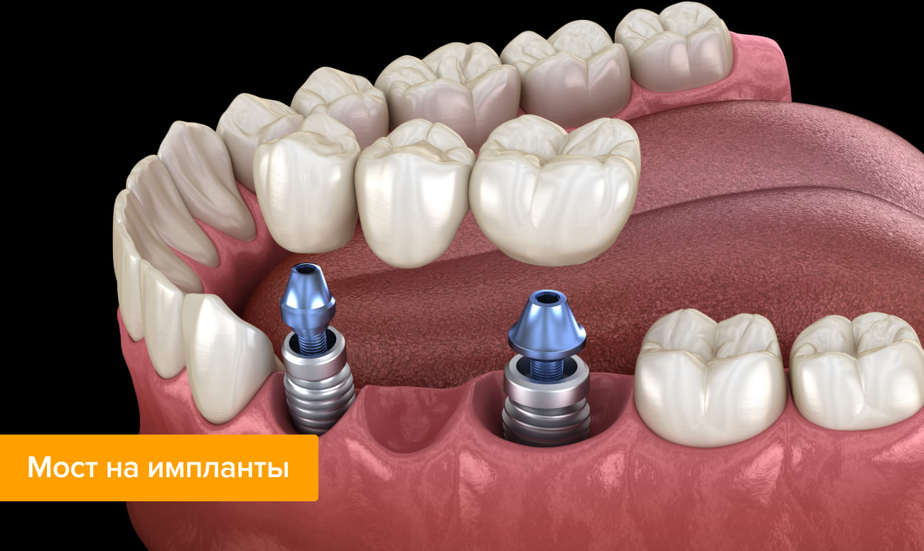 Стоматология мост что это такое