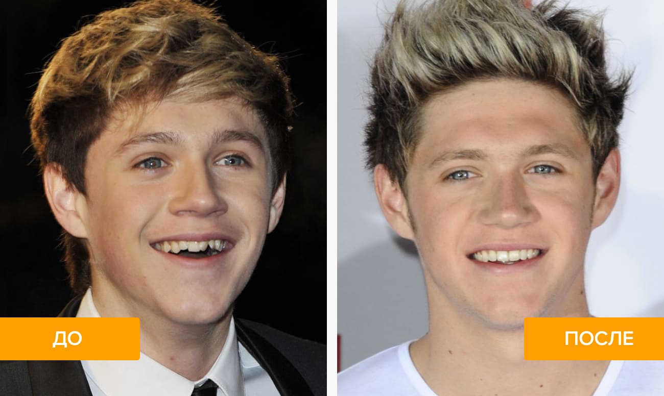 Фото кривых зубов Найла Хорана до и после лечения