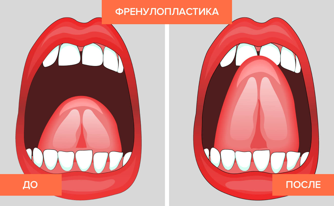 Пластика уздечки языка в картинках