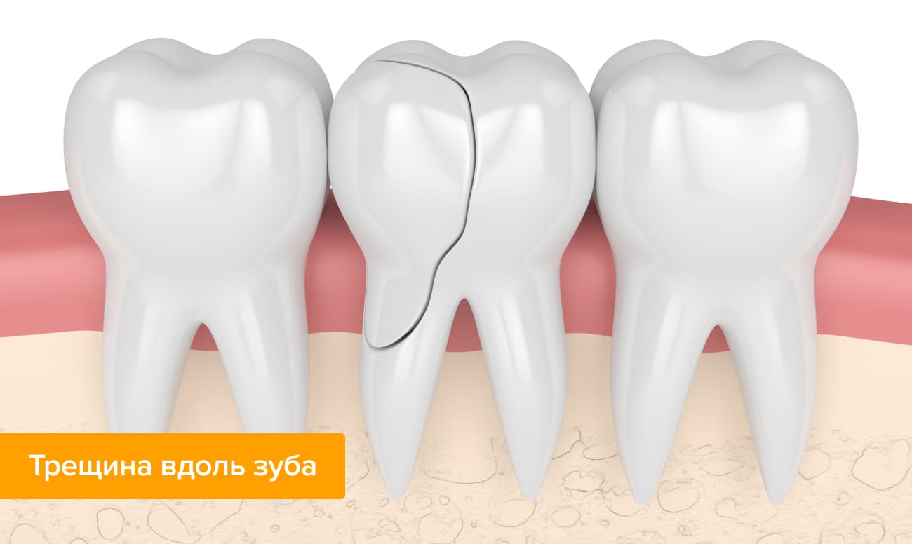 Фото трещины вдоль зуба