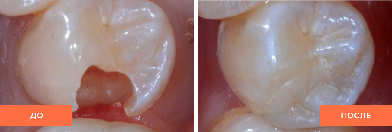Фото пациента до и после установки зубной вкладки