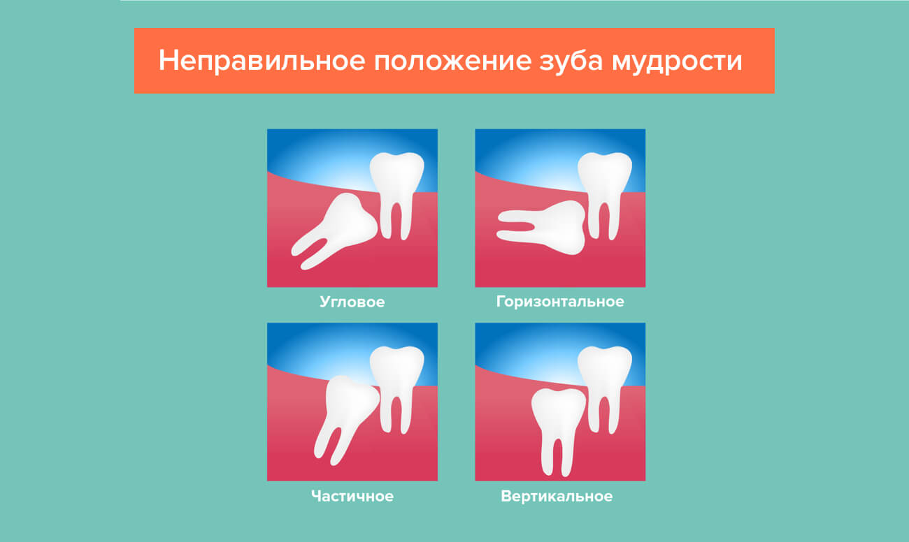 Виды дистопии зуба мудрости – угловое, горизонтальное, вертикальное, частичное.