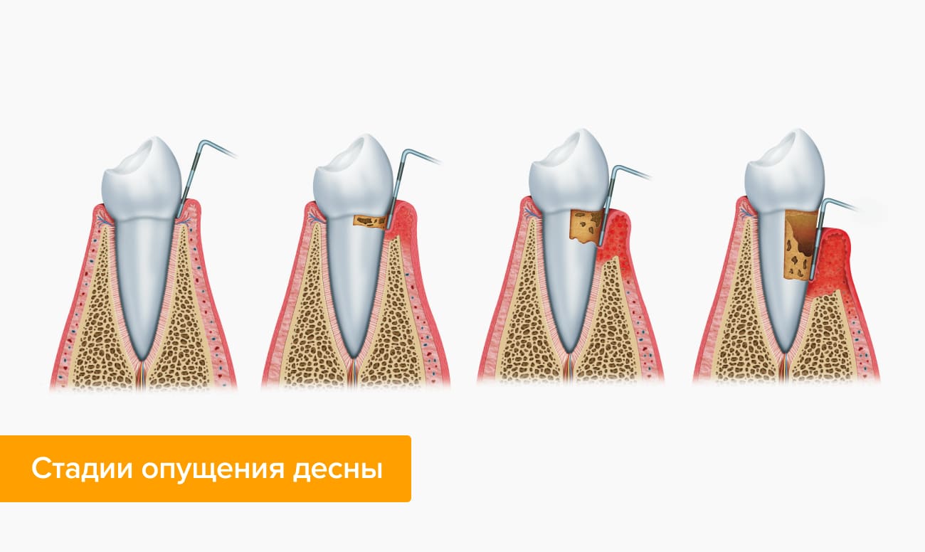 Стадии опущения десны в картинках