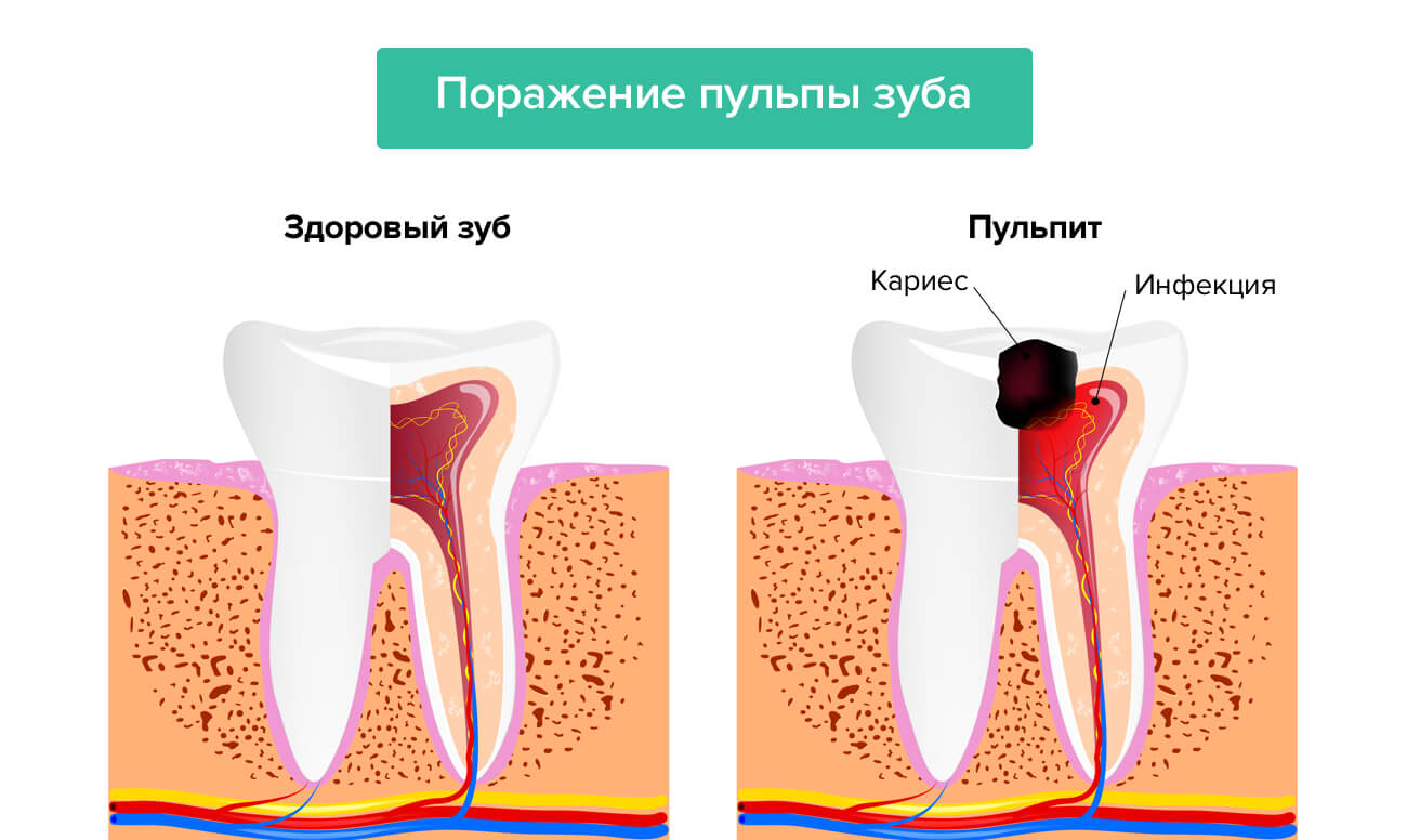 Поражение пульпы зуба в картинках