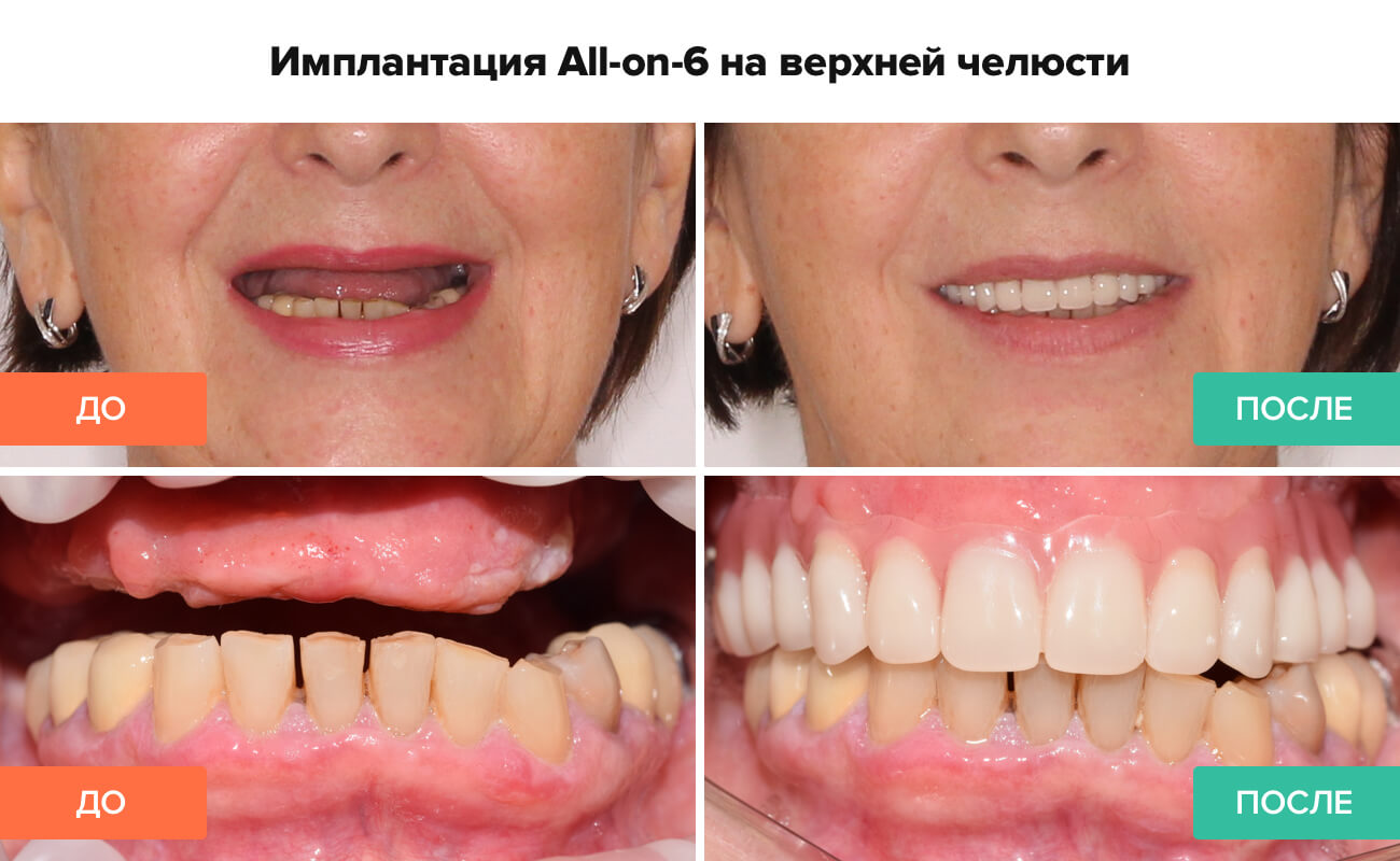 Фото до и после имплантации All-on-6 на верхней челюсти Фото пациента до и после имплантации All-on-6 на верхней челюсти