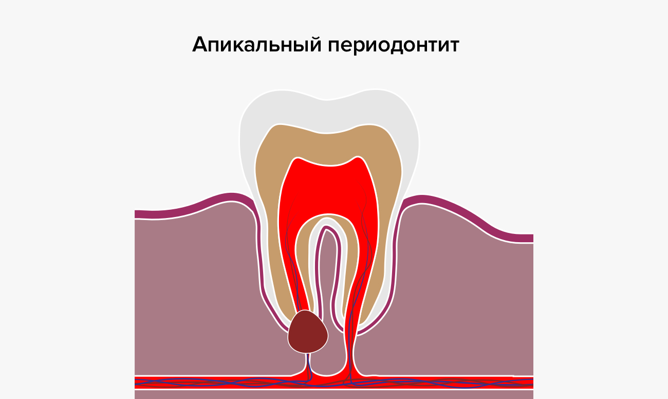 Апикальный периодонтит в картинках