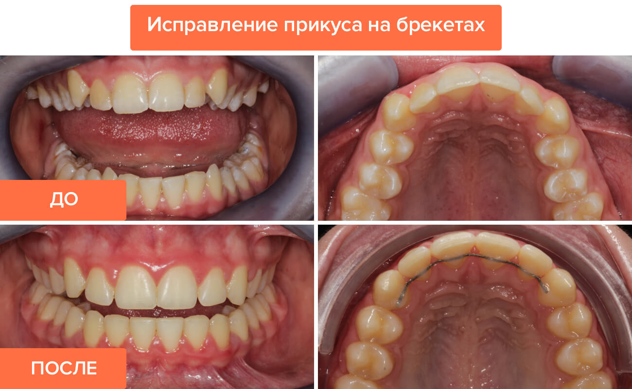 Фото зубов до и после лечения брекетами