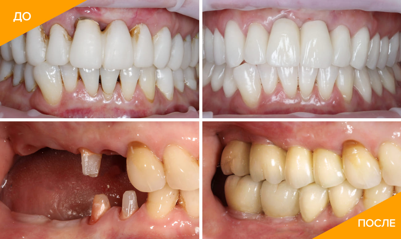 Фото пациента до и после имплантации зубов