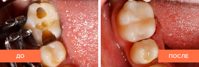 Фото пациента до и после установки пломбы зуба