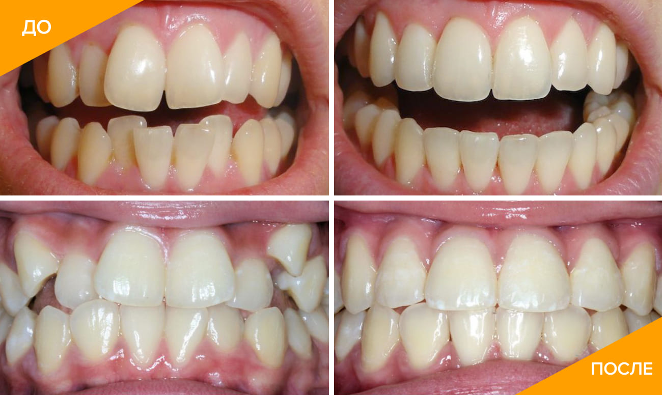 Фото зубов пациента до и после лечения элайнерами Orthosnap 
