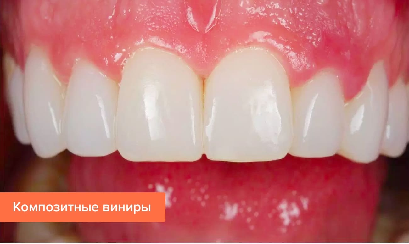 Фото композитных виниров