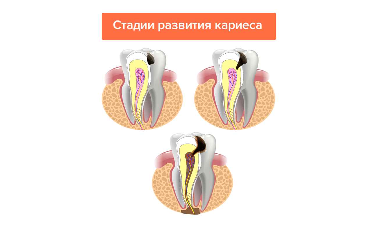 Стадии развития кариеса в картинках